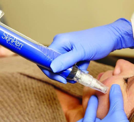 Microneedling behandling | Microneedling | SkinPen