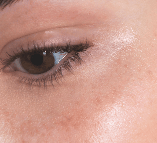 Skinko e behandling | Skinko e Viscoderm