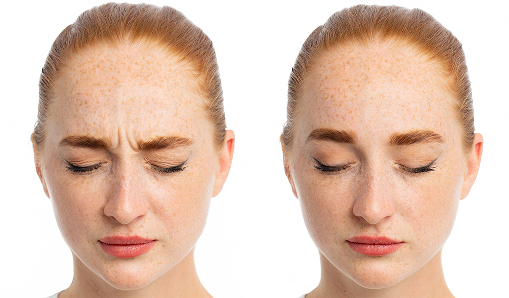 Botox bekymringsrynke