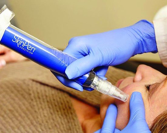 Microneedling SkinPen