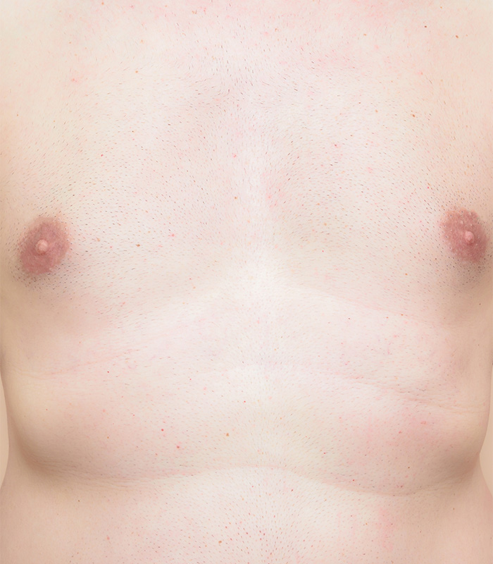 permanent-haarfjerning-foer-bryst-efter