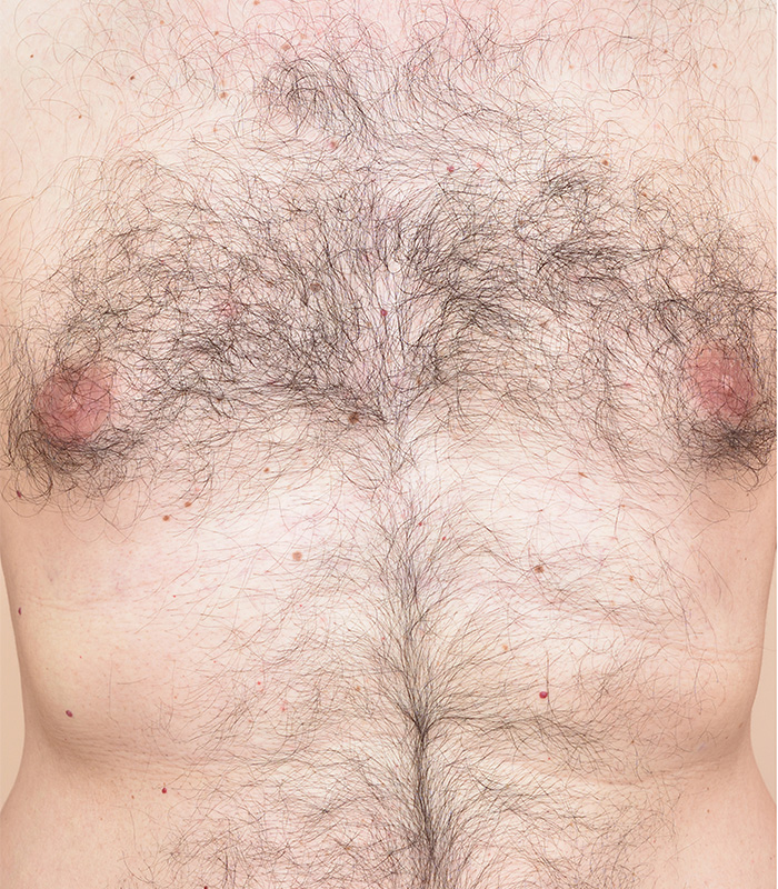 permanent-haarfjerning-foer-bryst-foer