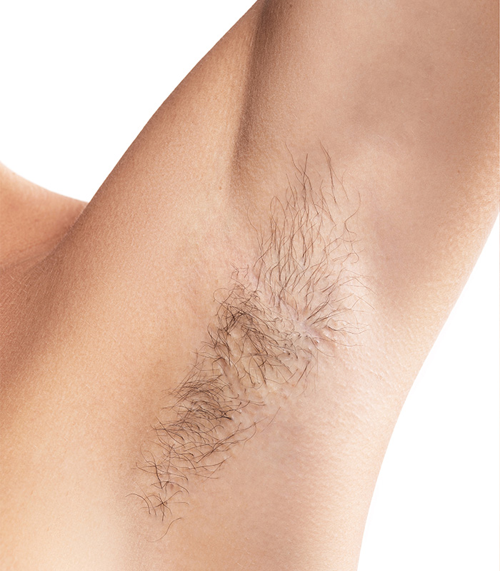 permanent-haarfjerning-foer-under-armene-foer