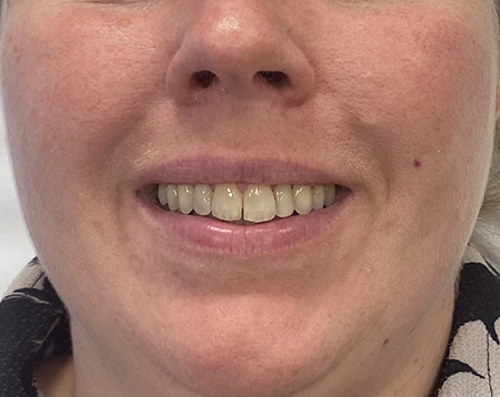 Gummy Smile Efter Behandlingen