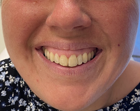 Gummy Smile Før Behandlingen
