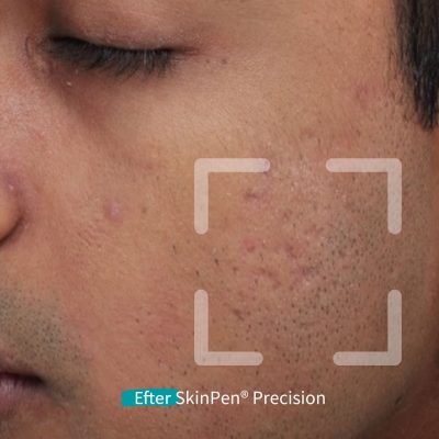 Microneedling SkinPen før og efter 12