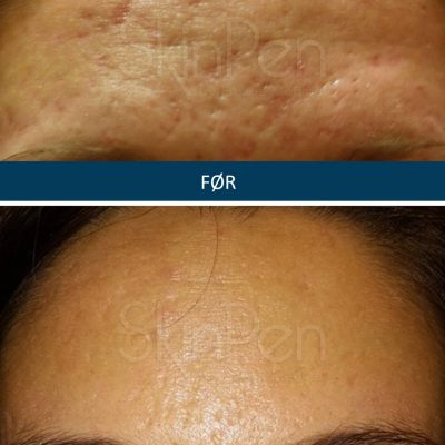 Microneedling SkinPen før og efter 6