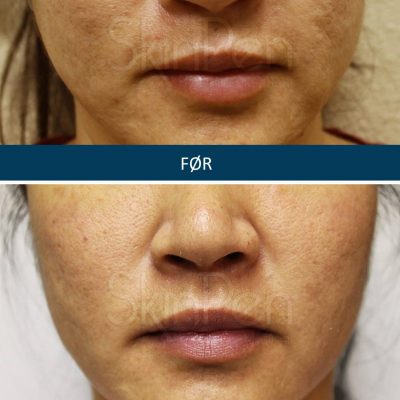 Microneedling SkinPen før og efter 7